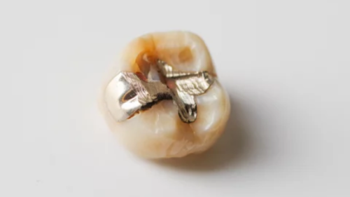 金歯は買取してもらえる？価格相場や売却時の注意点、おすすめの業者を解説